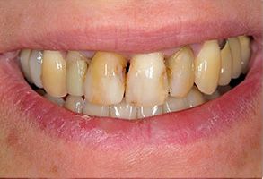 Kenny Williams, DDS | Sports Mouthguards, Snoring Appliances and Veneers
